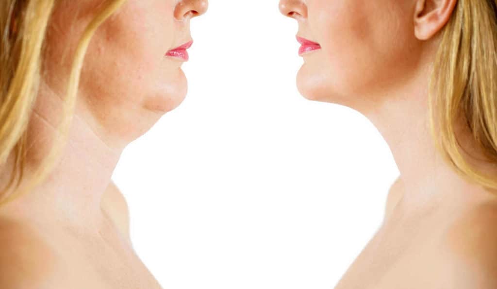 Double Chin treatment Camden Town before and after results