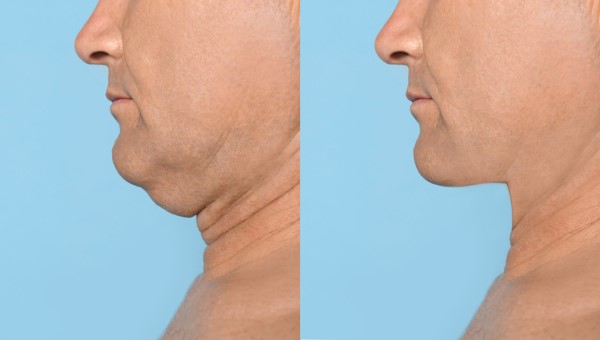 Which Non-Surgical Treatments Work Best for Jowls and Loose Skin Camden Town?