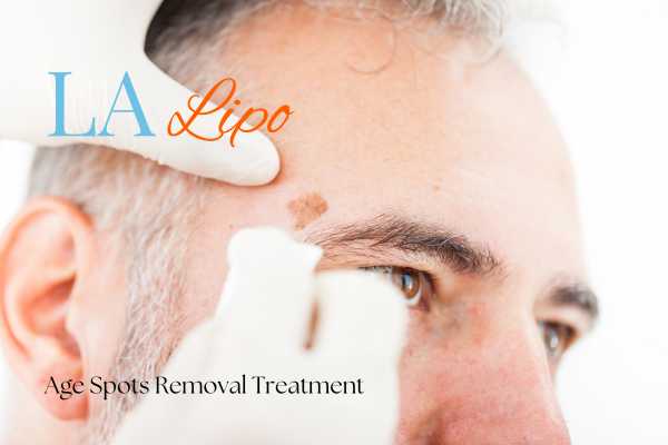 What Are the Most Effective Treatments for Age Spots Camden Town?