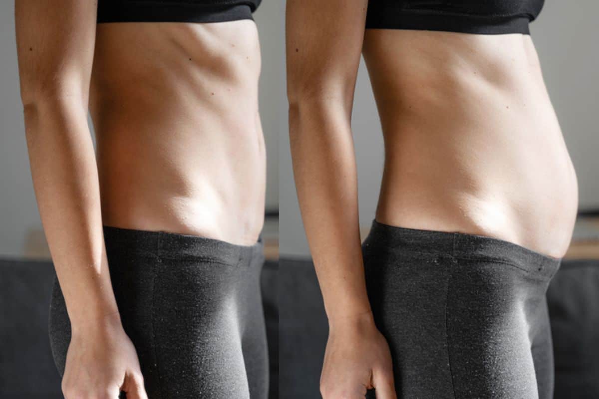 How long does diastasis recti take to improve Camden Town?