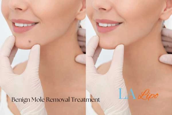 woman's before and after mole removal Camden Town results