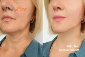 hi-fu for wrinkles Camden Town before and after results