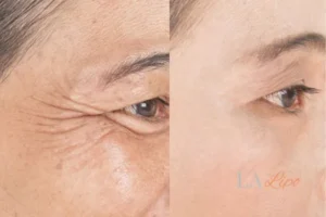 Before and after results of woman - HI-fu wrinkles reduction treatment Camden Town