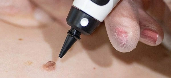 skin tag removal using cryopen Camden Town