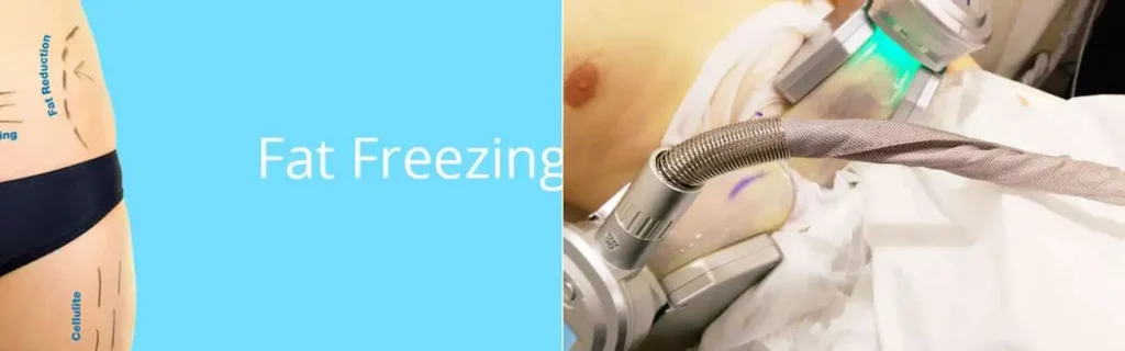 Fat freezing Camden Town on multiple areas of the body