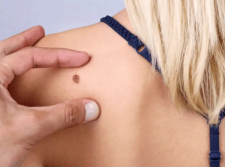 woman having mole removal Camden Town consultation before treatment.