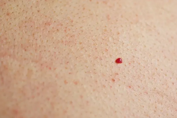 close up of a cherry angioma Camden Town