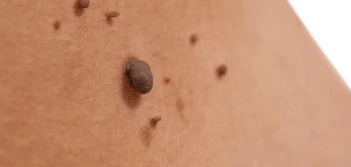 image of a skin tag Camden Town