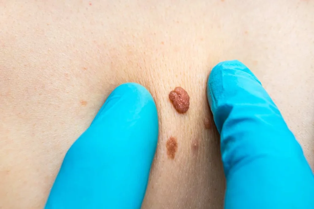 Consultant examining a skin tag Camden Town