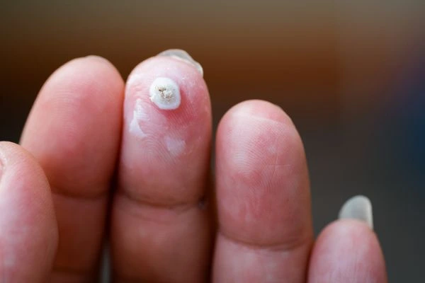 wart on person finger - cryotherapy to treat from LA LIPO Camden Town