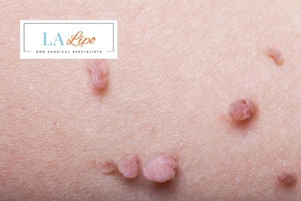 Does cryopen skin tag removal Camden Town hurt? Find out now call our team today!