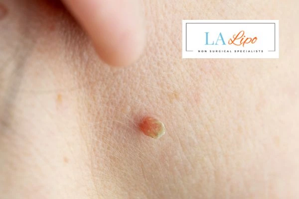 Book skin tag removal Camden Town today speak to our team now!