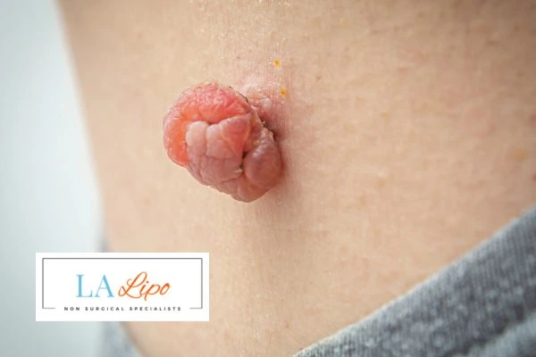 Interested in skin tag removal Camden Town? Concerned about the pain? Find out more today!