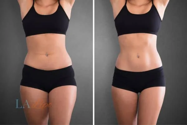 before and after results of non-surgical treatment to help a woman's body image and mental health Camden Town