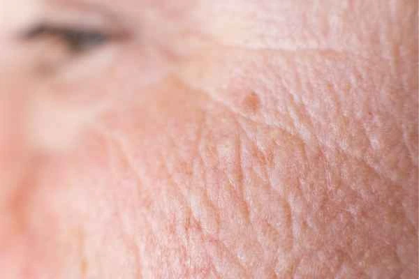 close up picture of a woman's face showing an age spot Camden Town