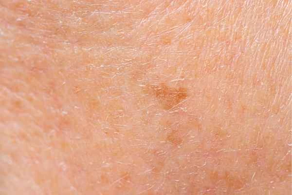 close up picture of age spots Camden Town