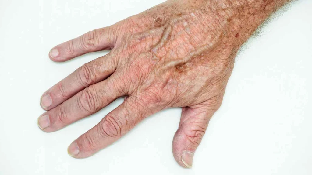 Male hand showing age spot Camden Town