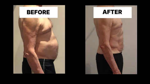 What Symptoms Can Diastasis Recti Cause in Men? Weak Core, Back Pain and Poor Posture Camden Town